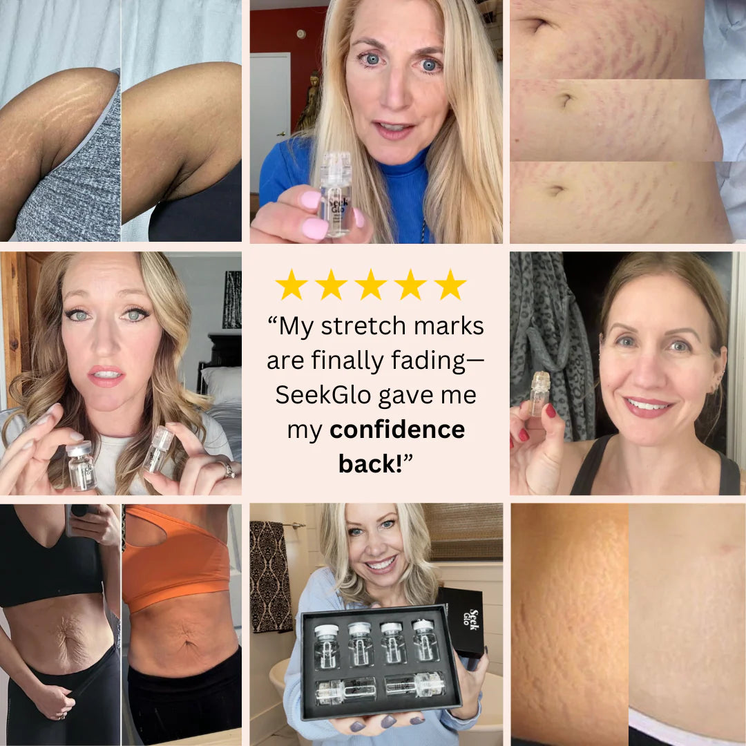 SeekGlo Stretch Mark System