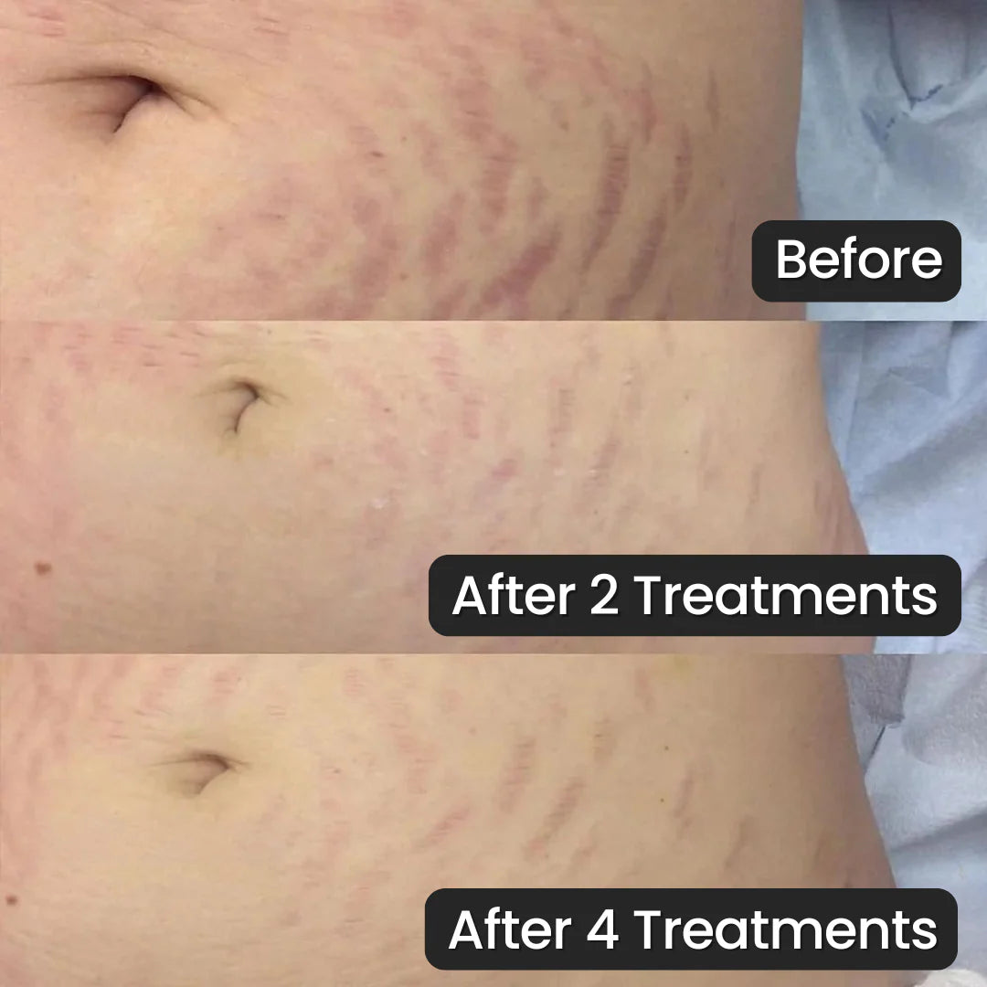 SeekGlo Stretch Mark System
