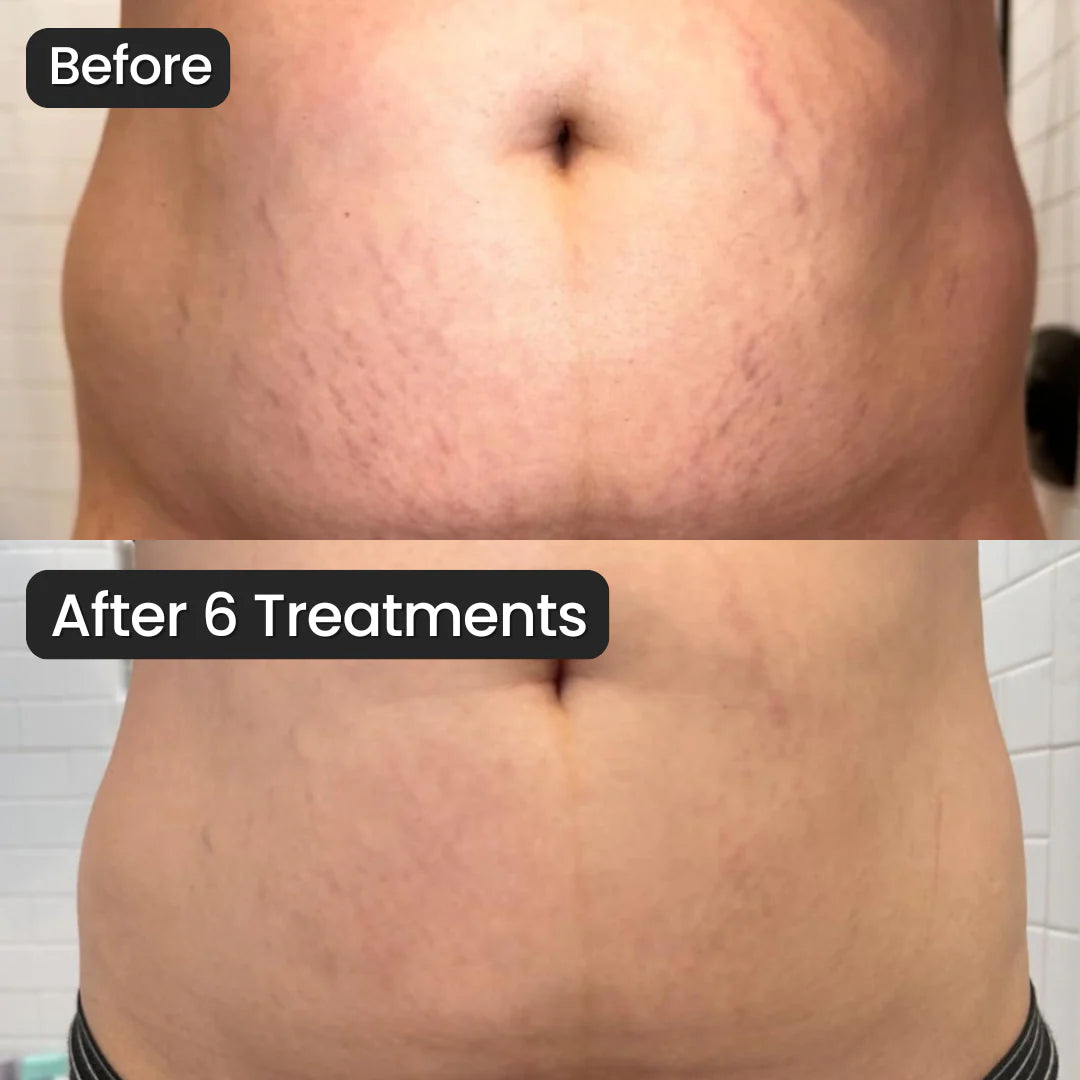 SeekGlo Stretch Mark System