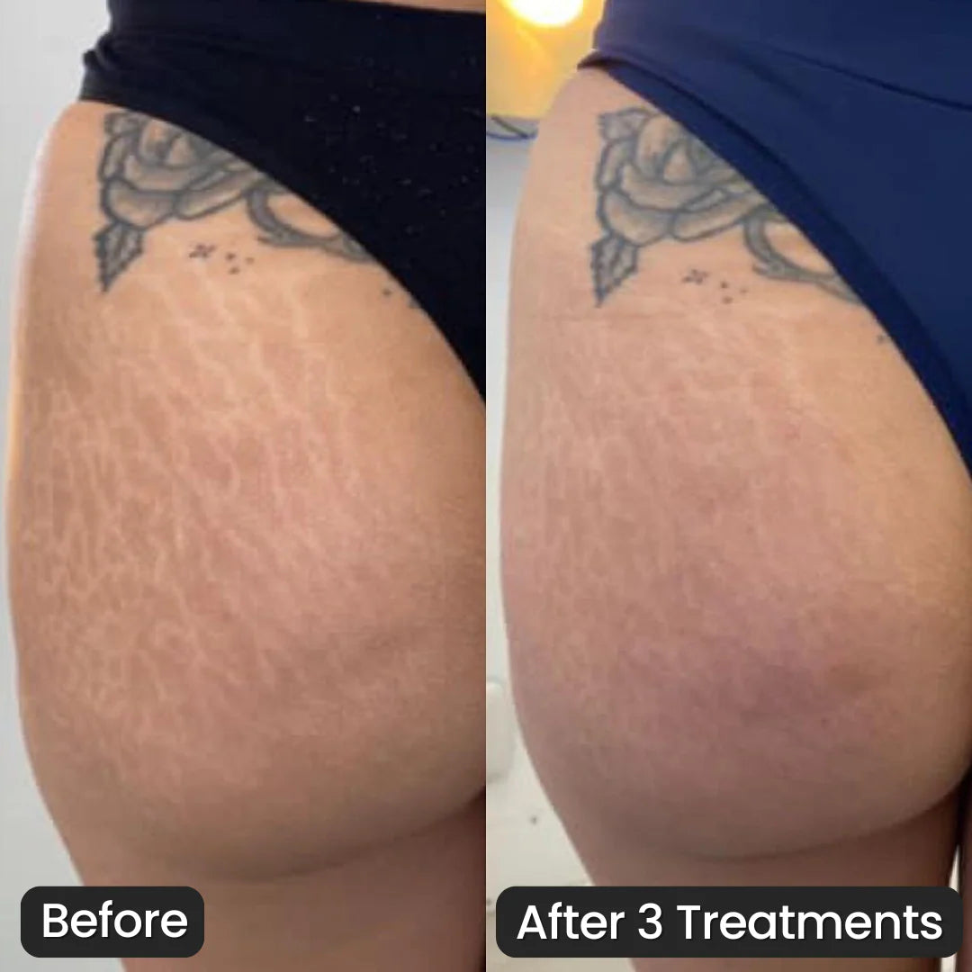 SeekGlo Stretch Mark System